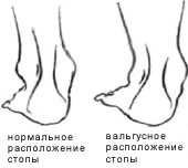 Если диагноз плоскостопие подтвердился