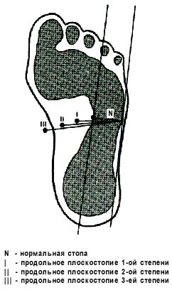 Если диагноз плоскостопие подтвердился